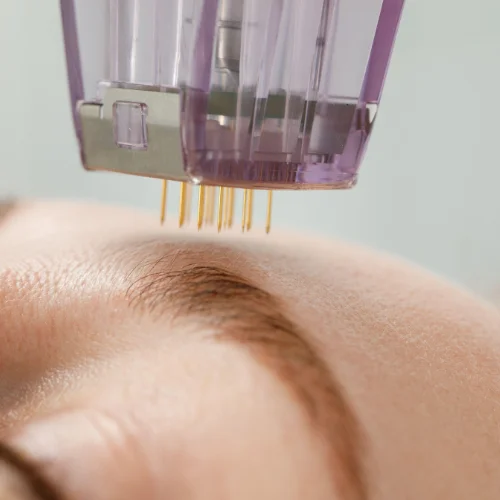 Microneedling